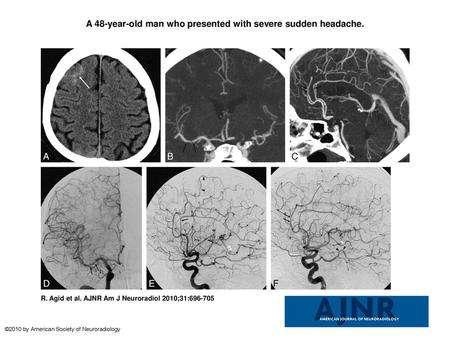 A 48-year-old man who presented with severe sudden headache.