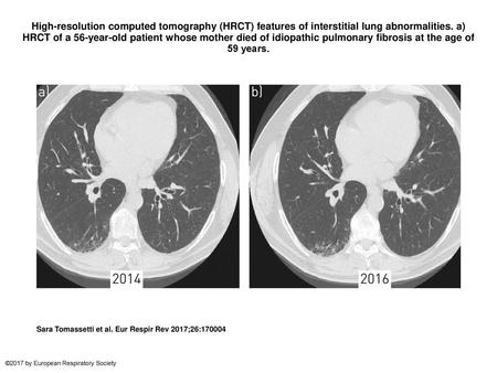 High-resolution computed tomography (HRCT) features of interstitial lung abnormalities. a) HRCT of a 56-year-old patient whose mother died of idiopathic.