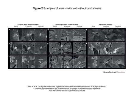Figure 2 Examples of lesions with and without central veins