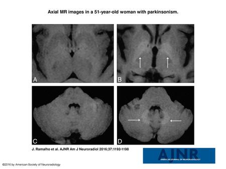 Axial MR images in a 51-year-old woman with parkinsonism.
