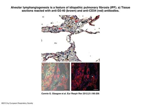 Alveolar lymphangiogenesis is a feature of idiopathic pulmonary fibrosis (IPF). a) Tissue sections reacted with anti-D2-40 (brown) and anti-CD34 (red)