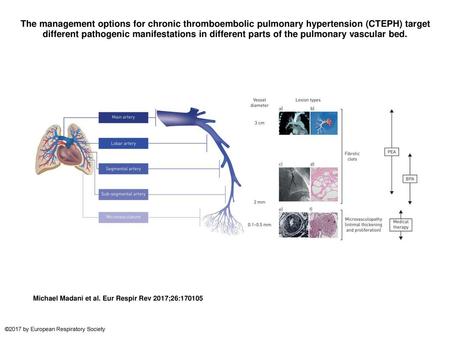 The management options for chronic thromboembolic pulmonary hypertension (CTEPH) target different pathogenic manifestations in different parts of the pulmonary.