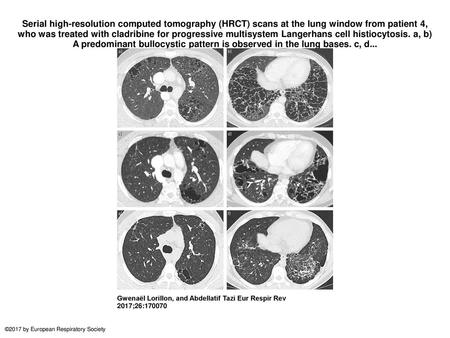 Serial high-resolution computed tomography (HRCT) scans at the lung window from patient 4, who was treated with cladribine for progressive multisystem.