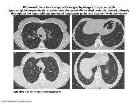 High-resolution chest computed tomography images of a patient with lymphangioleiomyomatosis, showing round-shaped, thin-walled cysts distributed diffusely.