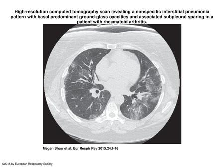 High-resolution computed tomography scan revealing a nonspecific interstitial pneumonia pattern with basal predominant ground-glass opacities and associated.