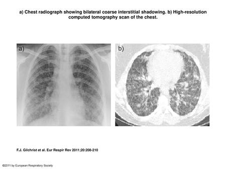 a) Chest radiograph showing bilateral coarse interstitial shadowing