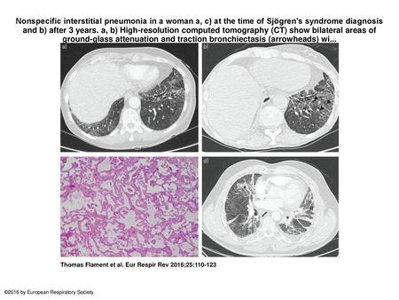 Nonspecific interstitial pneumonia in a woman a, c) at the time of Sjögren's syndrome diagnosis and b) after 3 years. a, b) High-resolution computed tomography.