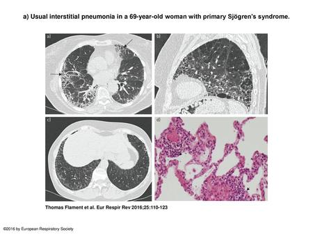 A) Usual interstitial pneumonia in a 69-year-old woman with primary Sjögren's syndrome. a) Usual interstitial pneumonia in a 69-year-old woman with primary.