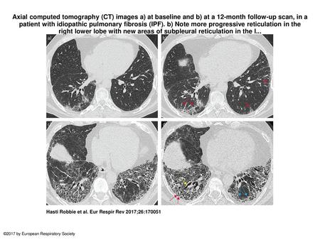 Axial computed tomography (CT) images a) at baseline and b) at a 12-month follow-up scan, in a patient with idiopathic pulmonary fibrosis (IPF). b) Note.