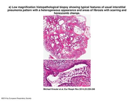 A) Low magnification histopathological biopsy showing typical features of usual interstitial pneumonia pattern with a heterogeneous appearance and areas.