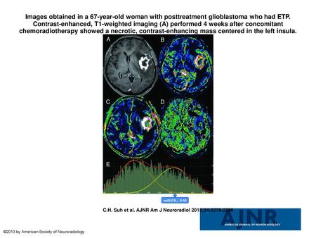 Images obtained in a 67-year-old woman with posttreatment glioblastoma who had ETP. Contrast-enhanced, T1-weighted imaging (A) performed 4 weeks after.