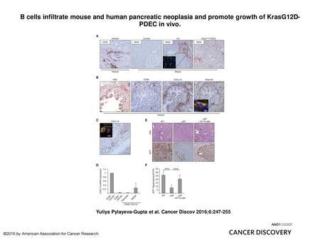 B cells infiltrate mouse and human pancreatic neoplasia and promote growth of KrasG12D-PDEC in vivo. B cells infiltrate mouse and human pancreatic neoplasia.