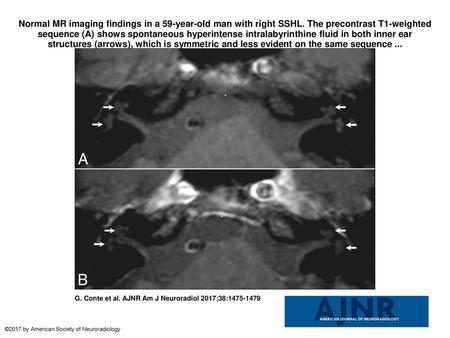 Normal MR imaging findings in a 59-year-old man with right SSHL