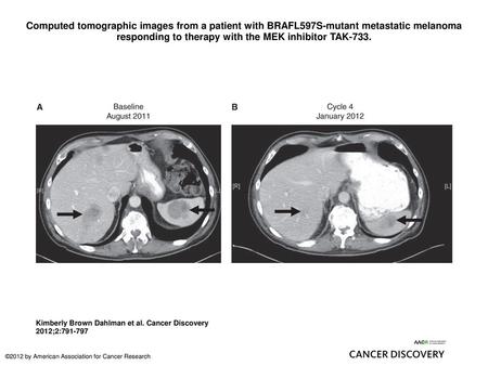 Computed tomographic images from a patient with BRAFL597S-mutant metastatic melanoma responding to therapy with the MEK inhibitor TAK-733. Computed tomographic.
