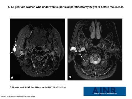 A, 55-year-old woman who underwent superficial parotidectomy 22 years before recurrence. A, 55-year-old woman who underwent superficial parotidectomy 22.