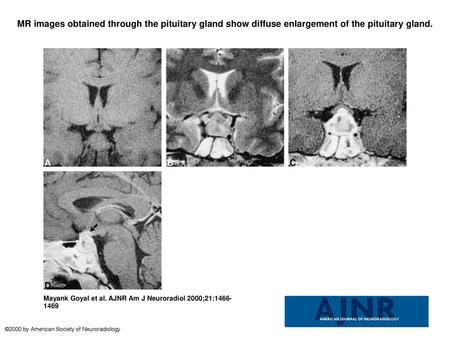 MR images obtained through the pituitary gland show diffuse enlargement of the pituitary gland. MR images obtained through the pituitary gland show diffuse.