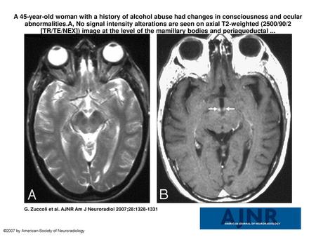 A 45-year-old woman with a history of alcohol abuse had changes in consciousness and ocular abnormalities.A, No signal intensity alterations are seen on.