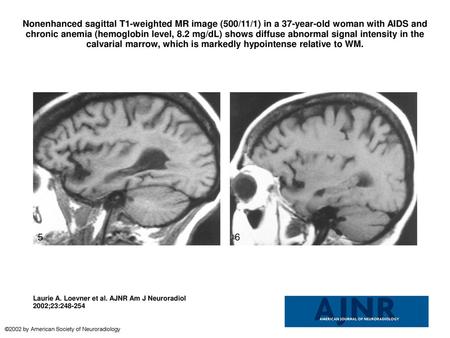 Nonenhanced sagittal T1-weighted MR image (500/11/1) in a 37-year-old woman with AIDS and chronic anemia (hemoglobin level, 8.2 mg/dL) shows diffuse abnormal.
