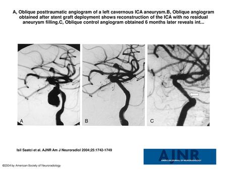 A, Oblique posttraumatic angiogram of a left cavernous ICA aneurysm