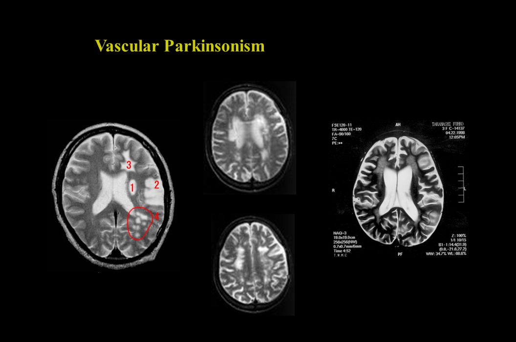 Vascular Parkinsonism
