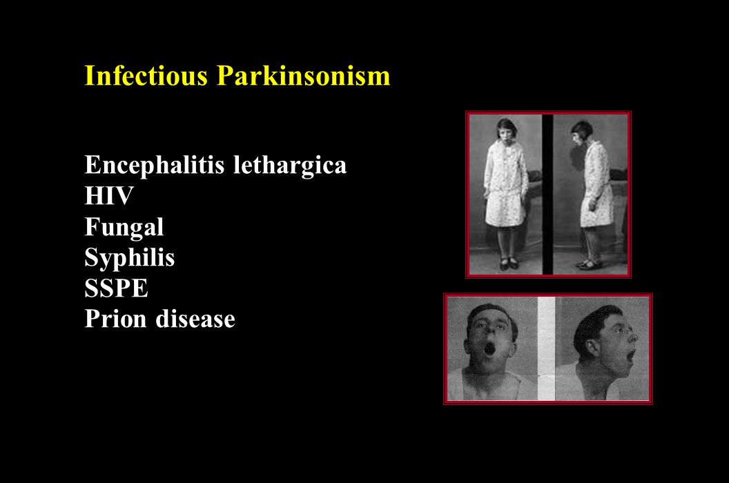Infectious Parkinsonism