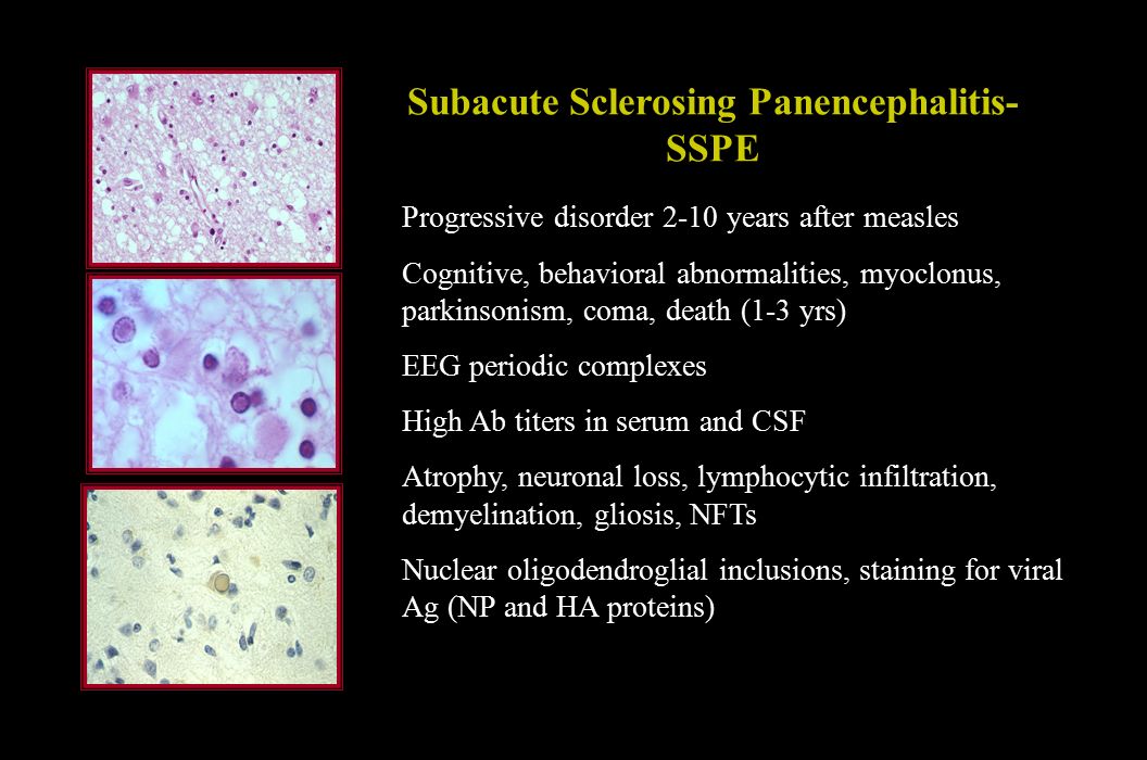 Subacute Sclerosing Panencephalitis-SSPE