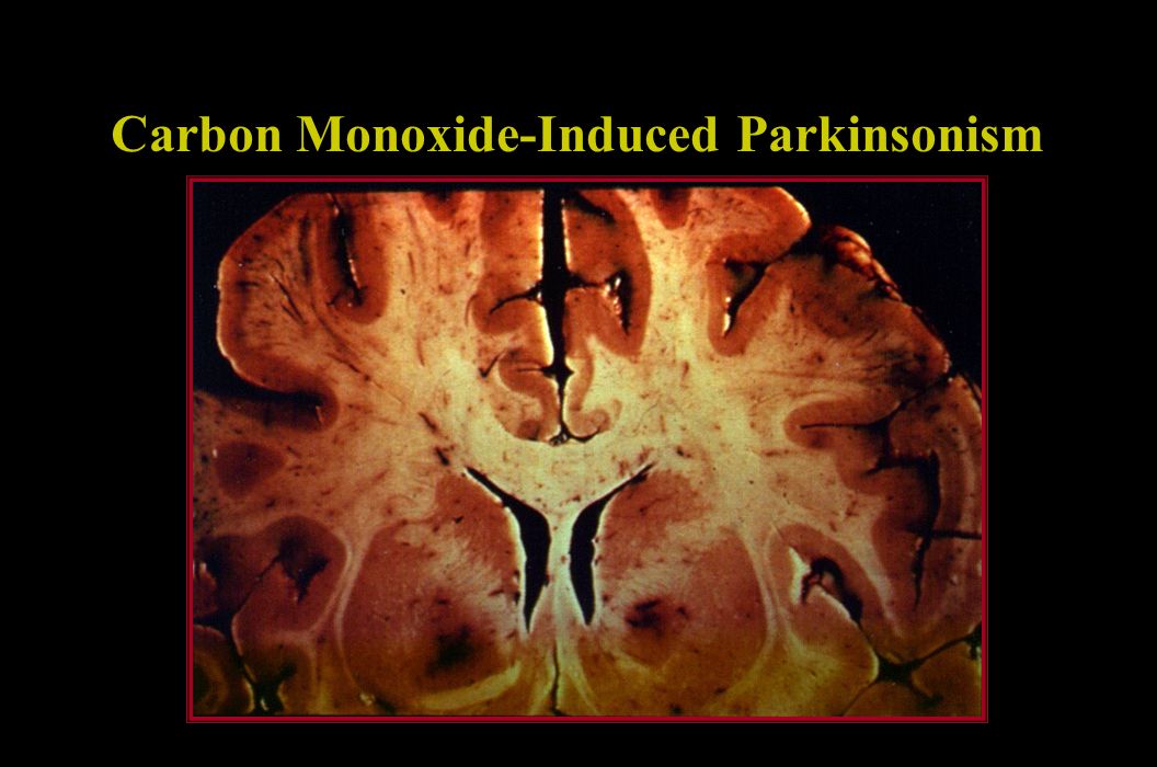 Carbon Monoxide-Induced Parkinsonism