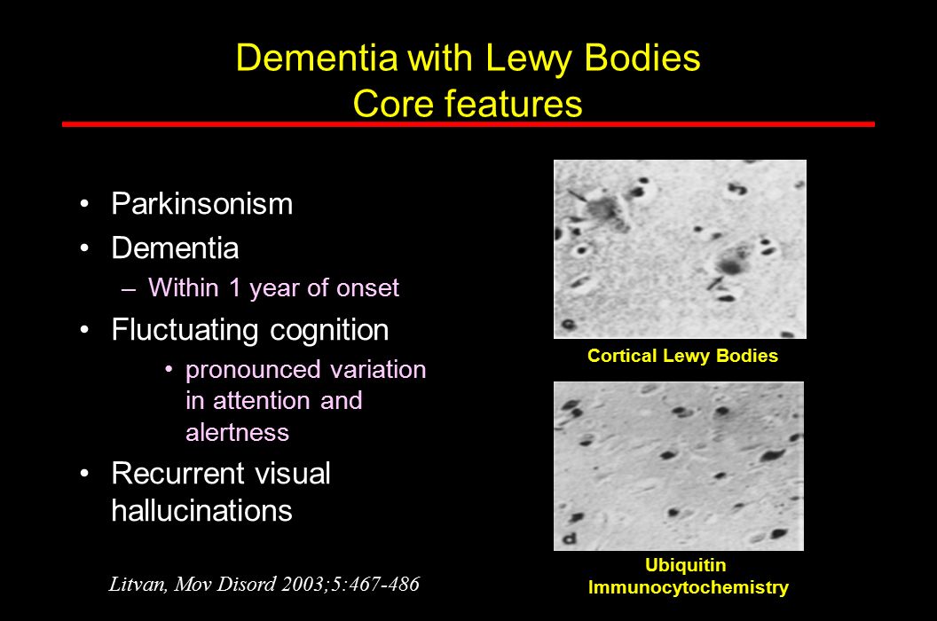 Dementia with Lewy Bodies Core features