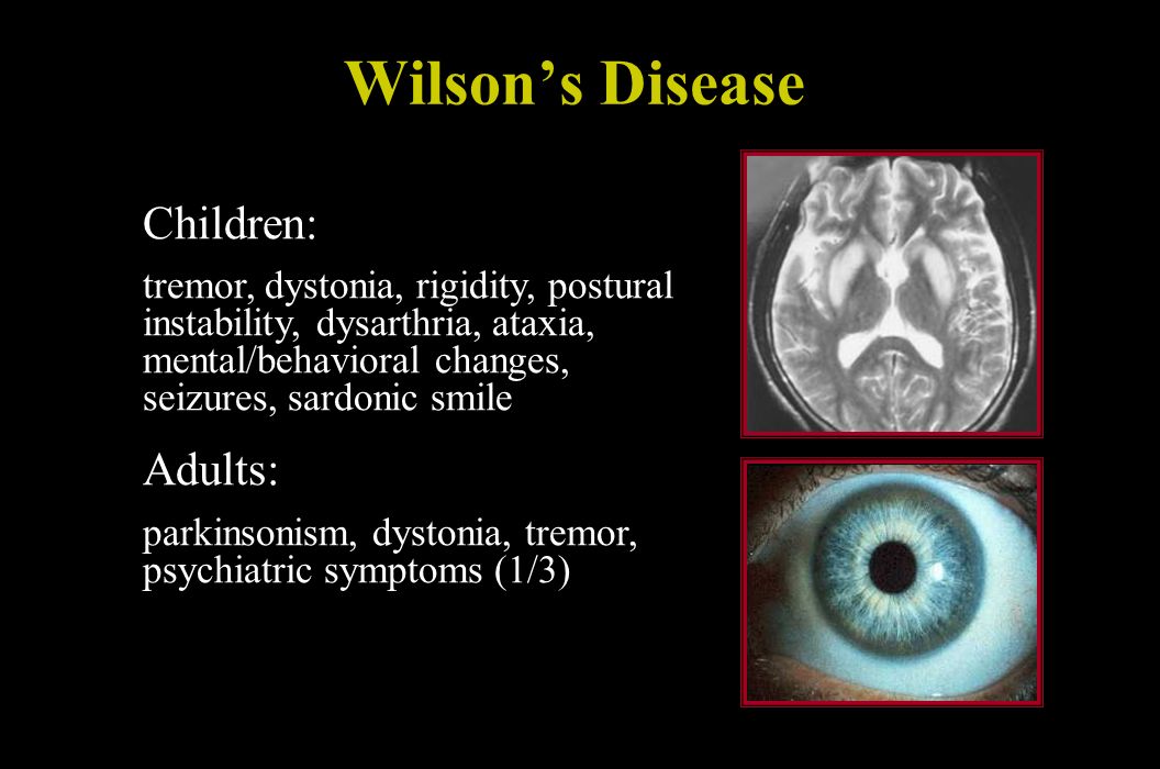 Children: Adults: Wilson’s Disease