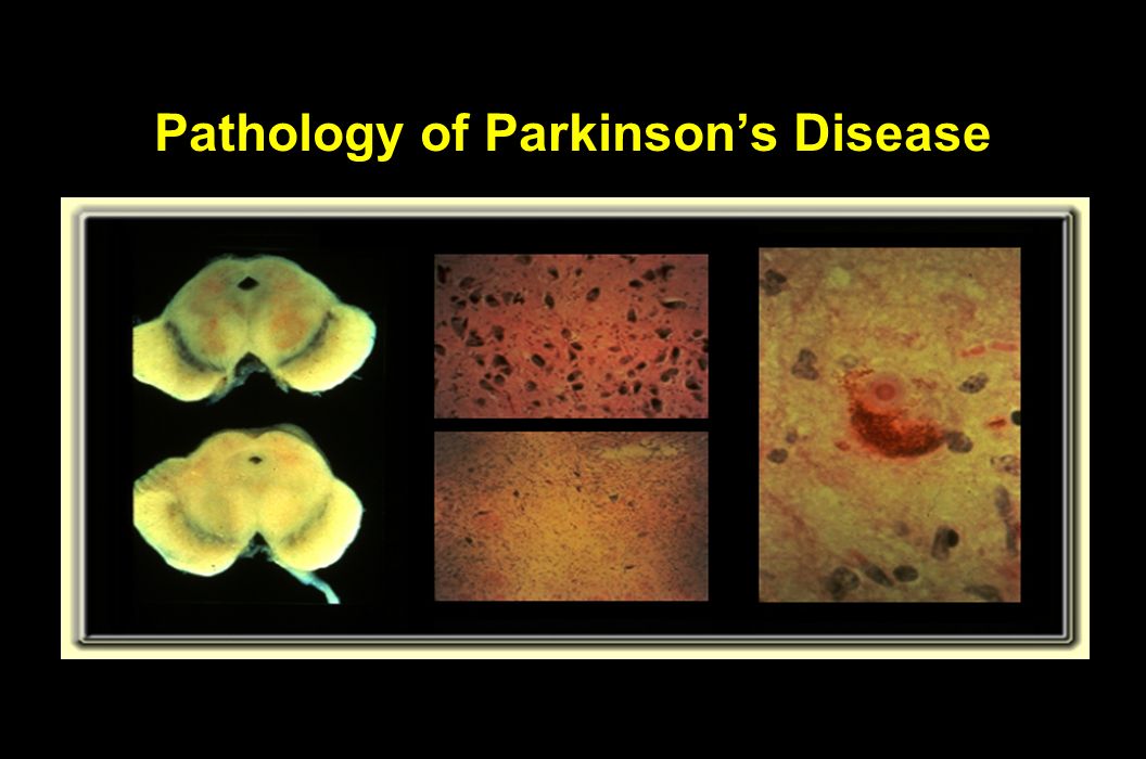 Pathology of Parkinson’s Disease