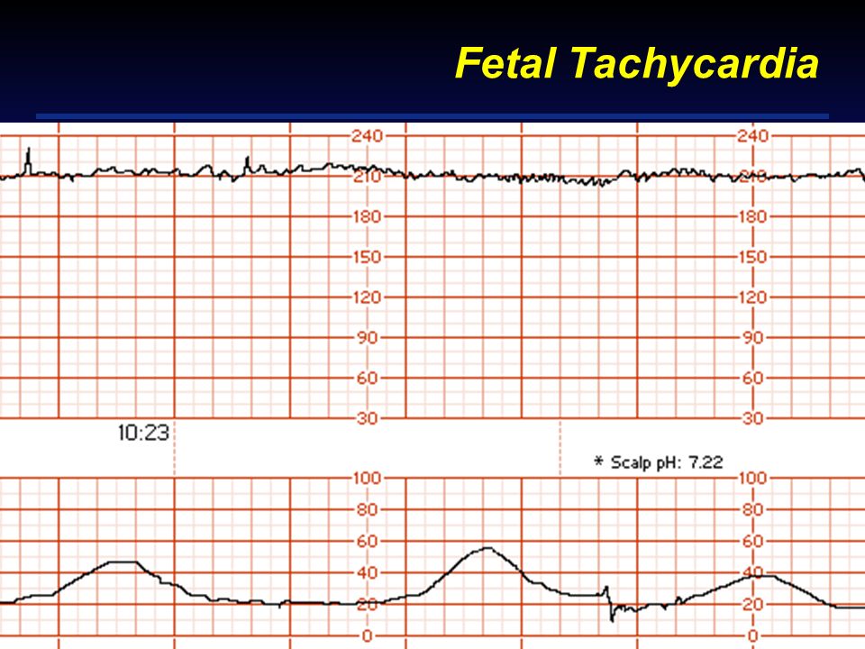 Fetal Tachycardia