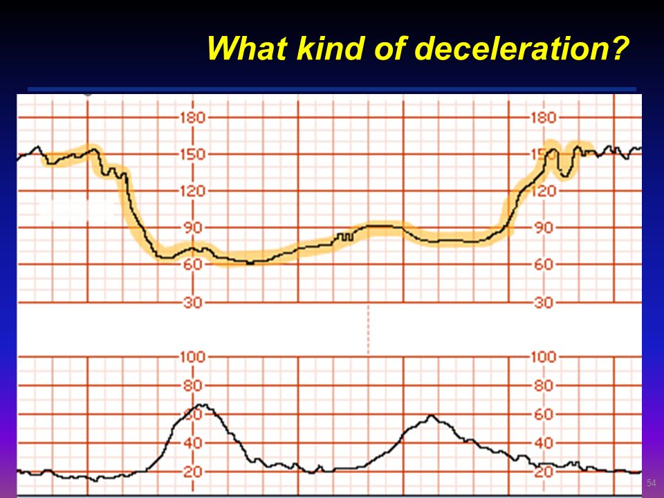 What kind of deceleration
