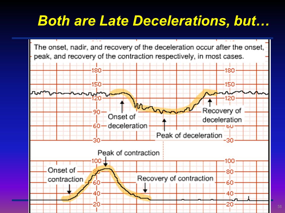 Both are Late Decelerations, but…