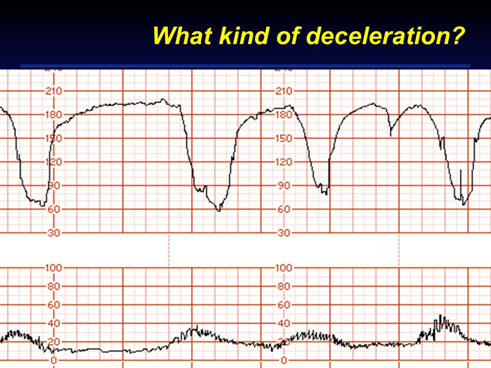 What kind of deceleration