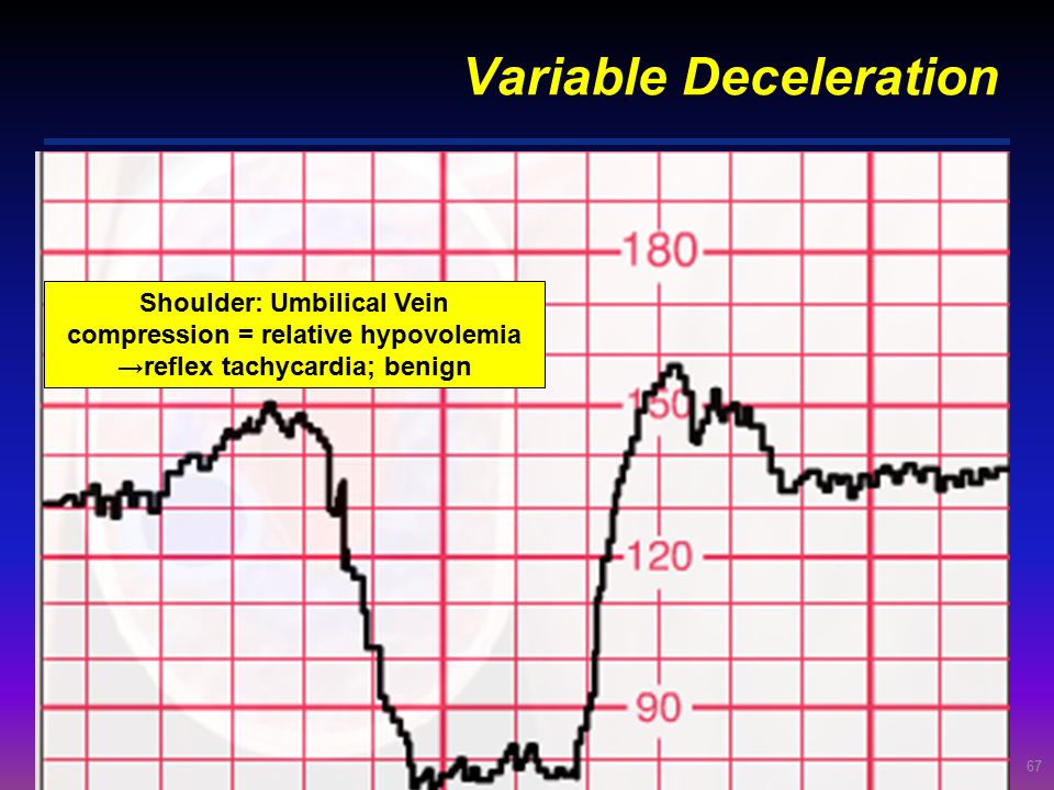Variable Deceleration