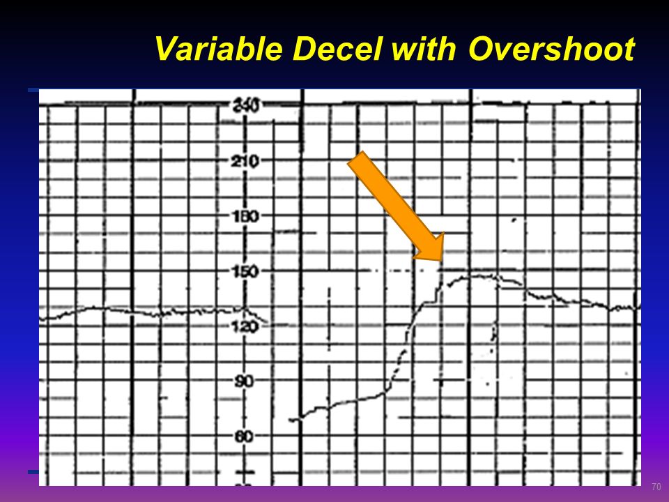 Variable Decel with Overshoot