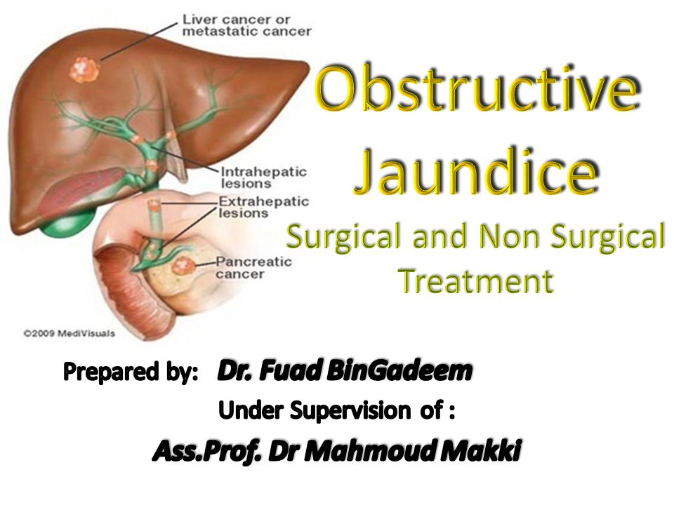 obstructive jaundice surgical and non surgical treatment obstructive jaundice