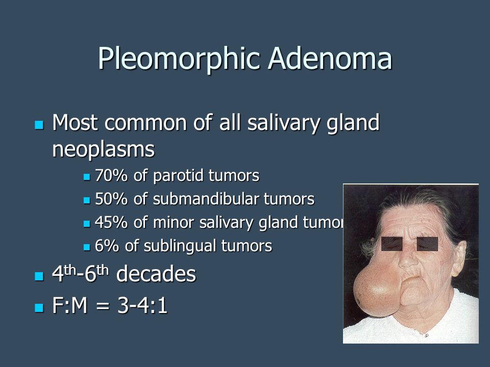 Pleomorphic Adenoma Most common of all salivary gland neoplasms