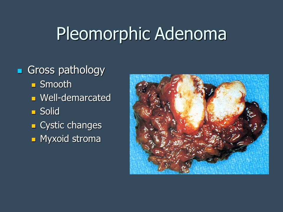 Pleomorphic Adenoma Gross pathology Smooth Well-demarcated Solid