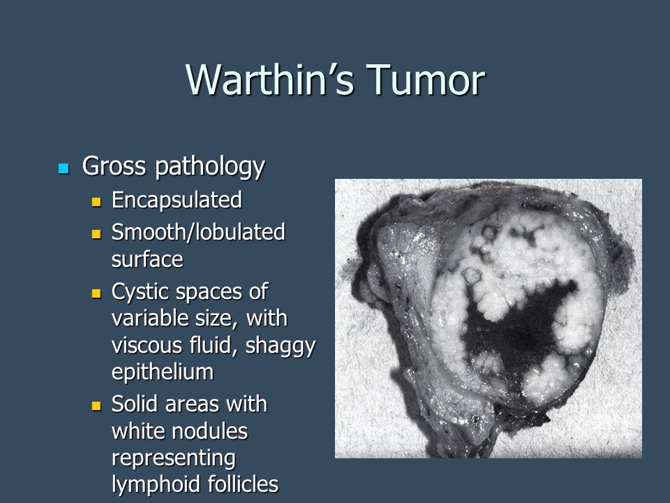 Warthin’s Tumor Gross pathology Encapsulated Smooth/lobulated surface
