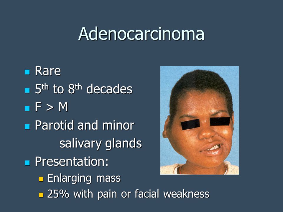 Adenocarcinoma Rare 5th to 8th decades F > M Parotid and minor