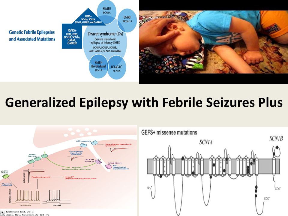 Generalized Epilepsy with Febrile Seizures Plus