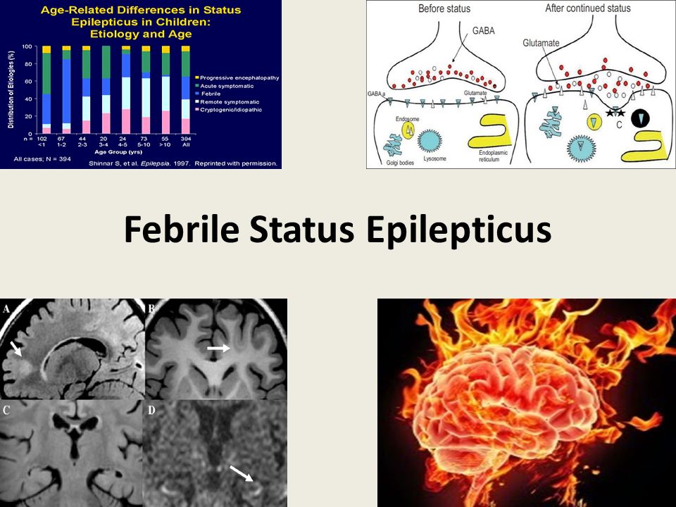 Febrile Status Epilepticus