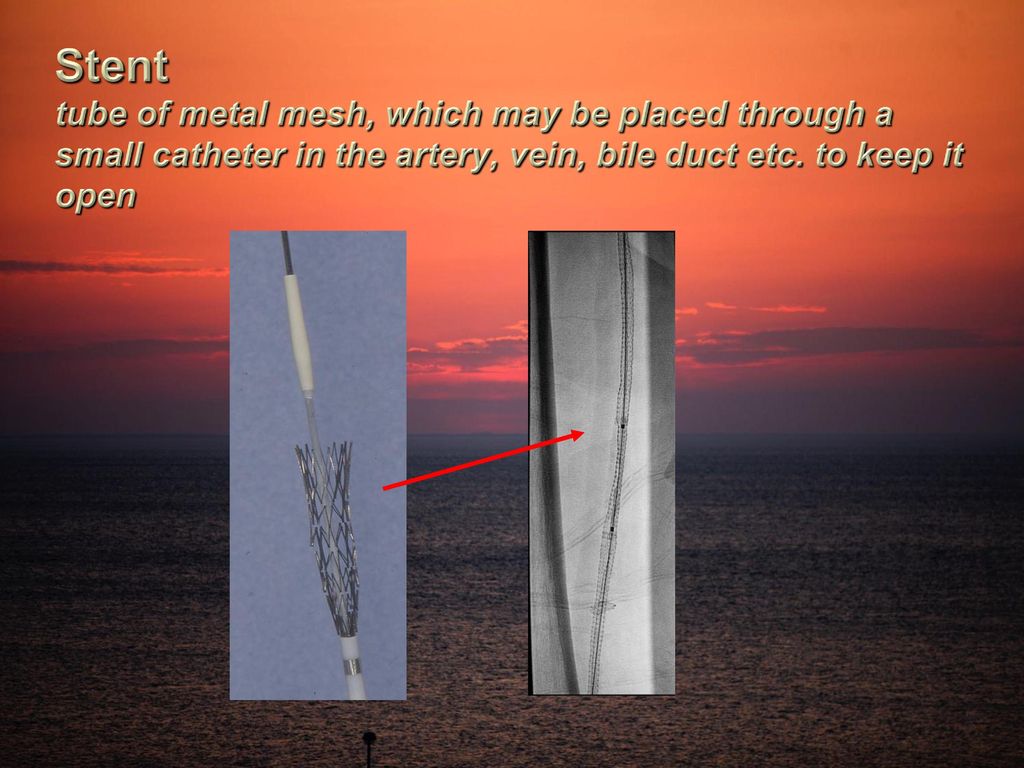 Stent tube of metal mesh, which may be placed through a small catheter in the artery, vein, bile duct etc.