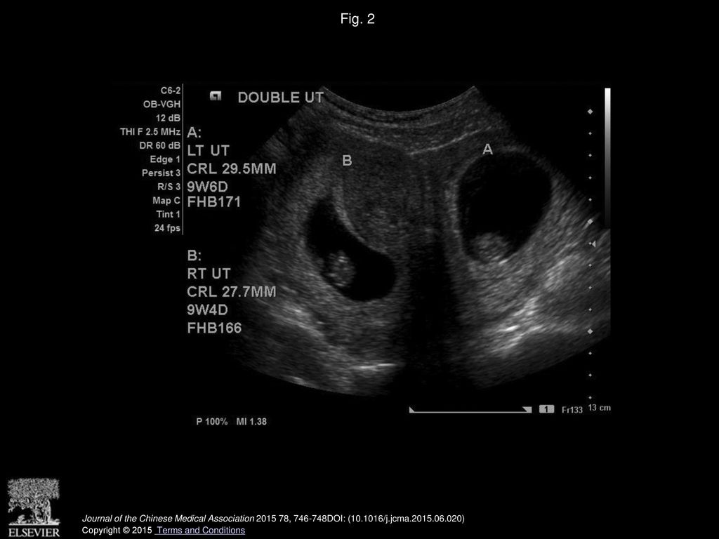 Fig. 2 Two embryos located separately with one in each uterus.