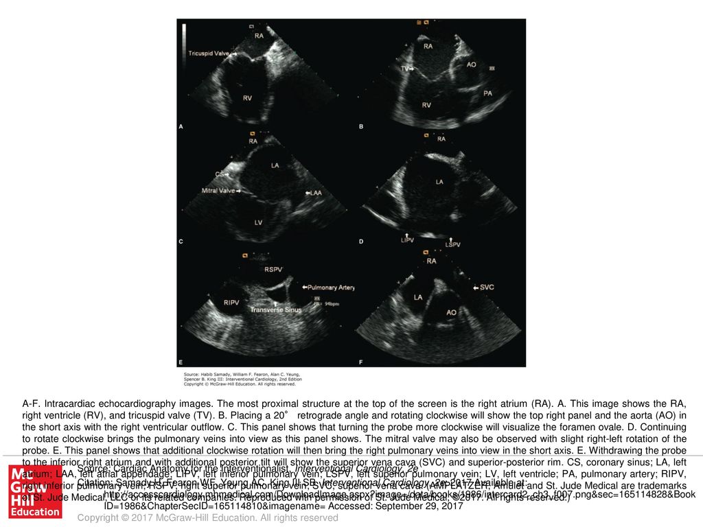 A-F. Intracardiac echocardiography images