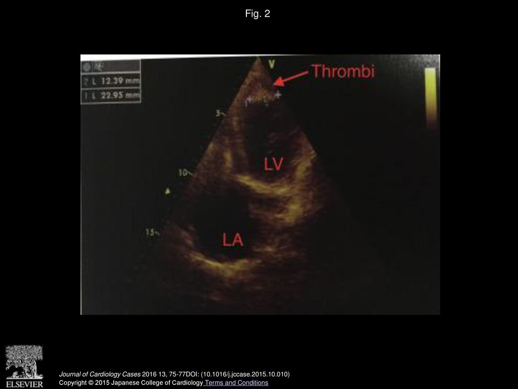 Fig. 2 Echocardiography with apical thrombus. LA, left atrium; LV, left ventricle.