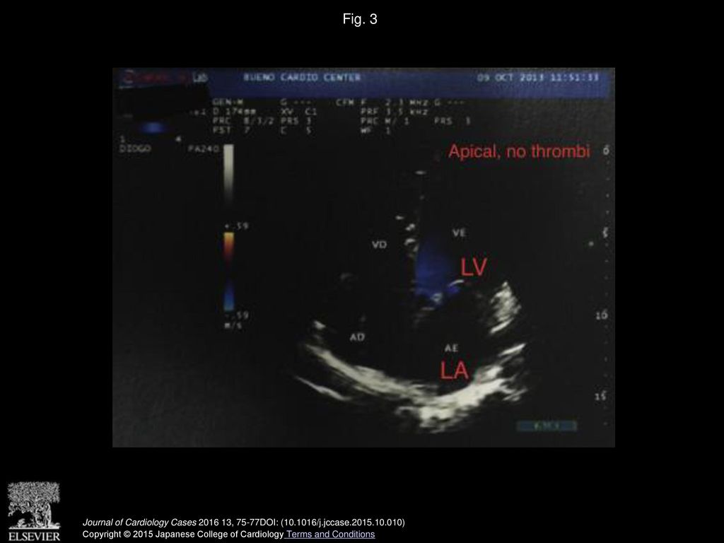 Fig. 3 Echocardiography without thrombus. LA, left atrium; LV, left ventricle.