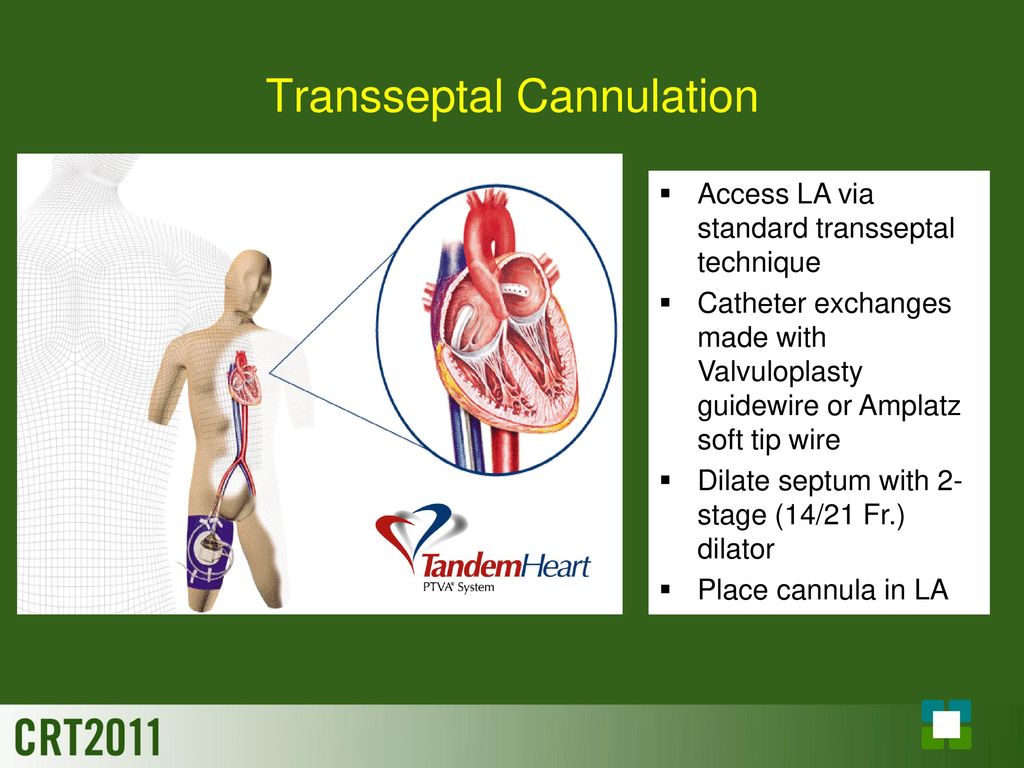 transseptal cannulation access la via standard transseptal