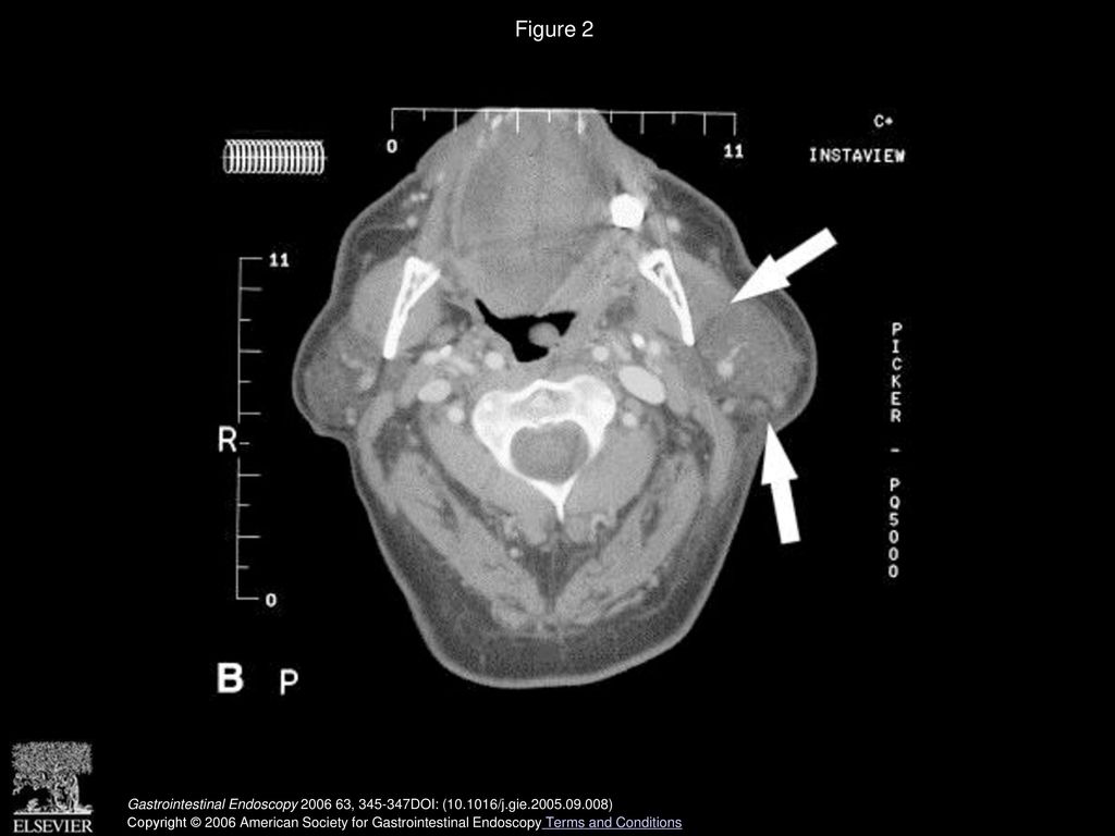 Figure 2 Swelling of the left submandibular gland (A) and the parotid gland (B).